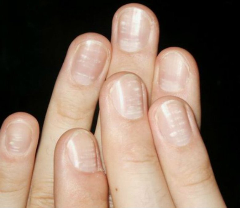 Почему появляются белые полоски на ногтях? – Салон красоты Винтаж, Лыткарино